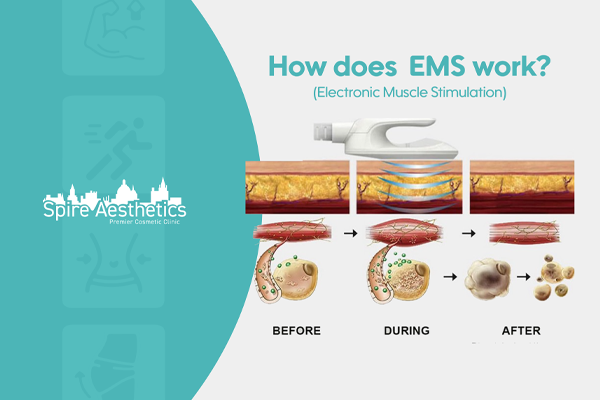 EMS treatment for post pregnancy weight loss treatment Abingdon