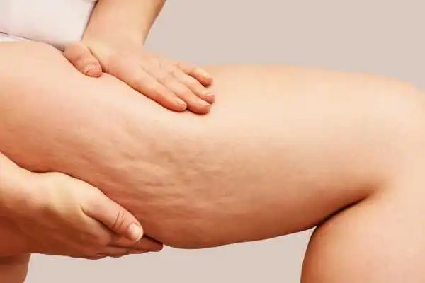 Image of woman showing leg with cellulite Abingdon