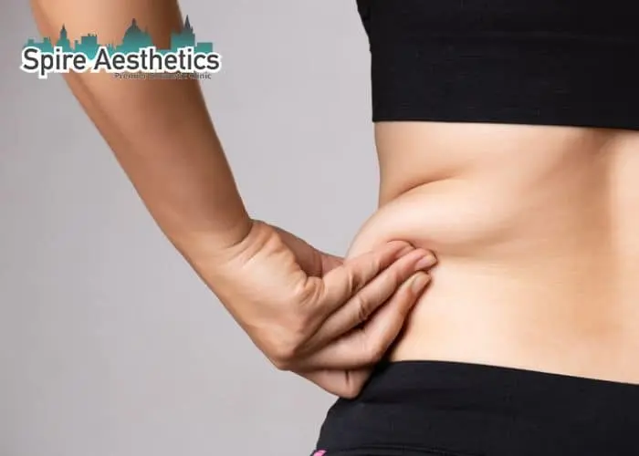 Image of woman pinching fat on their hips Abingdon. Fat Freezing treatment