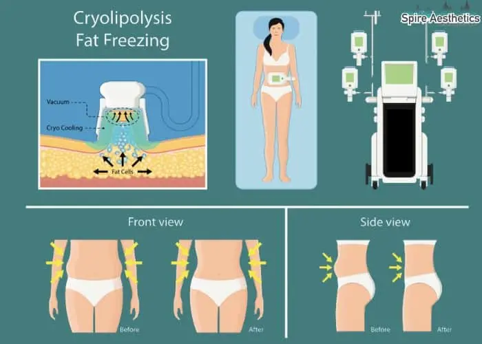 Fat freezing treatment Abingdon benefits for competitions to remove stubborn fat deposits.