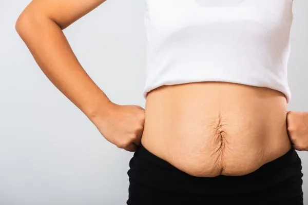 Image of a woman's stomach after weight loss with sagging skin following a gastric band Abingdon