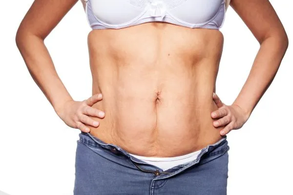 sagging skin on woman's stomach after weight loss injections Abingdon