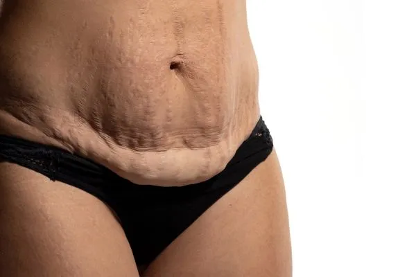Image of womans stomach after weight loss injections Abingdon showing saggy skin