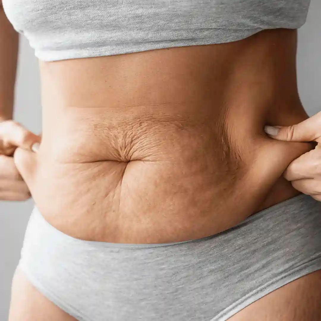 Is It Normal to Have Loose Skin After Pregnancy Abingdon?
