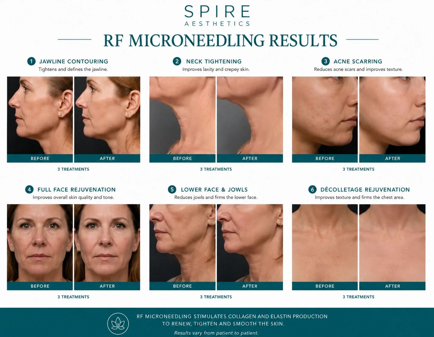 RF Microneedling Skin tightening Abingdon results