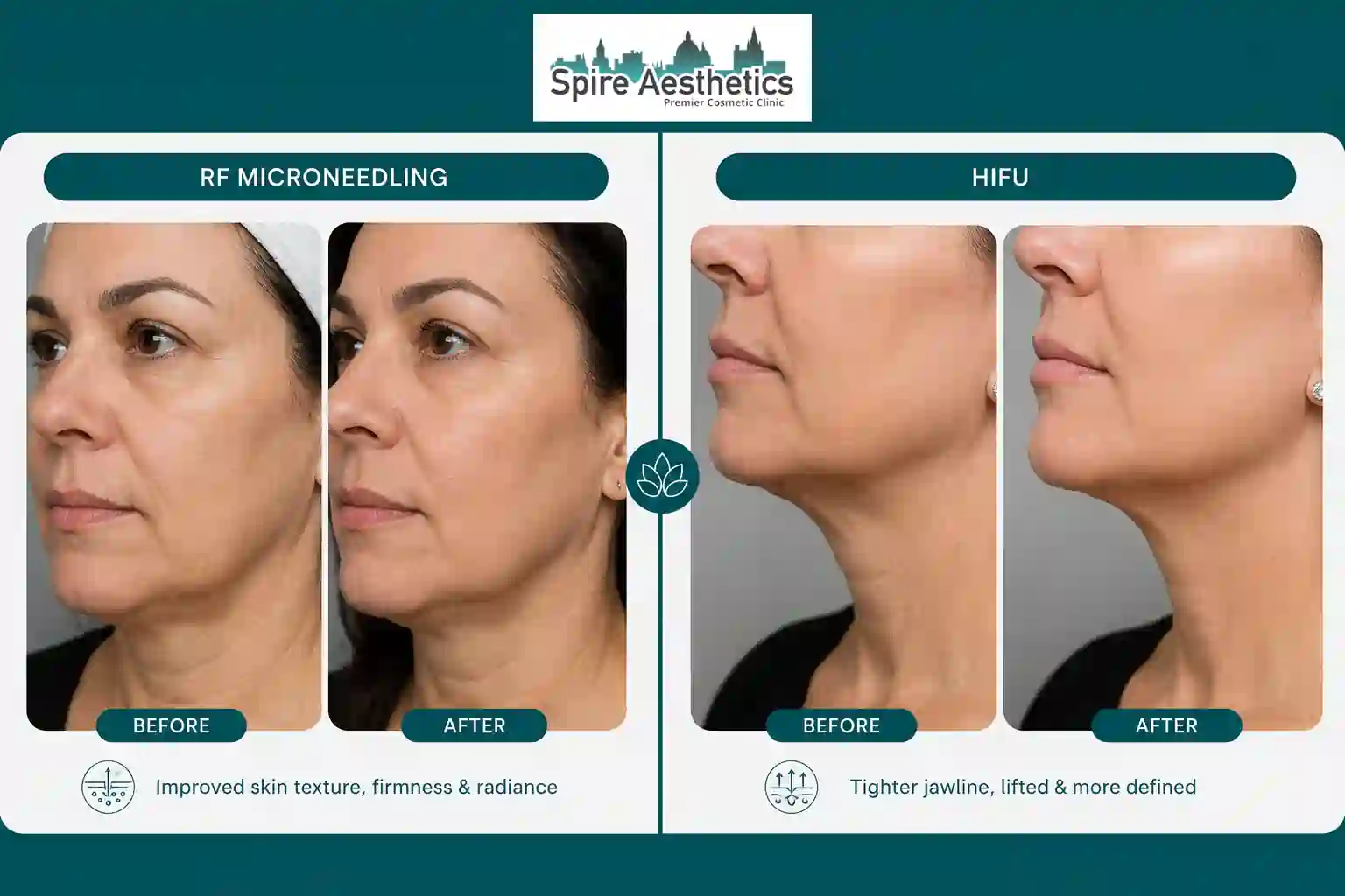 Can RF Microneedling and HIFU Be Combined Abingdon?
