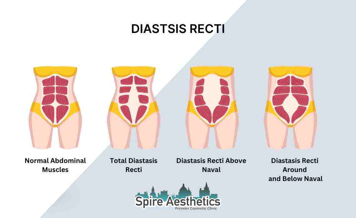 Is Non-Surgical Diastasis Recti Treatment Right for You? Common Concerns Answered Abingdon